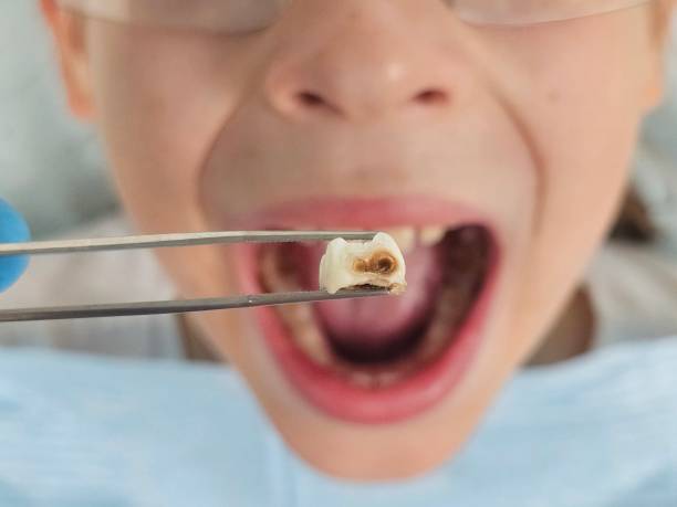 Teeth Whitening in NE